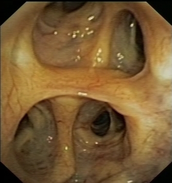 Quadrifurcation of the right upper lobe bronchus