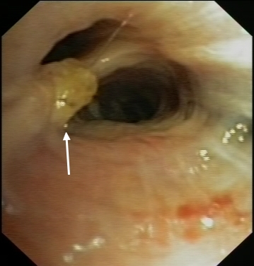 Irregular mucosa of a carina
