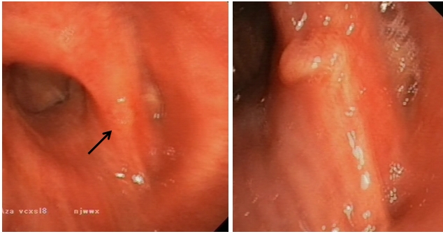 Nodular irregularity of the carina