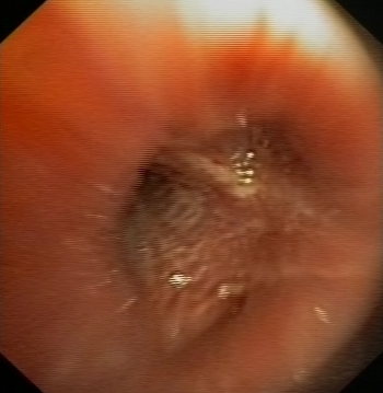 Distortion and infiltration of the carinas of the RUL