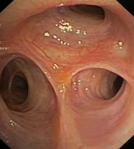 Normal carinas of the right upper lobe bronchus