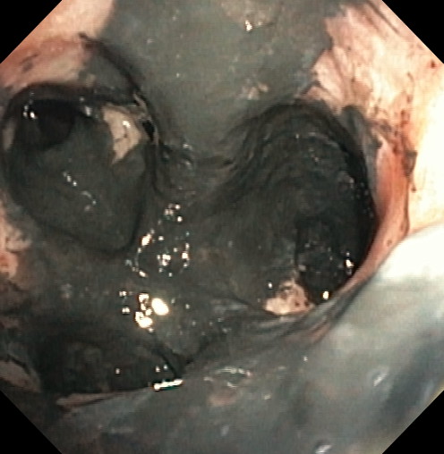Inhalation injury and soot deposition