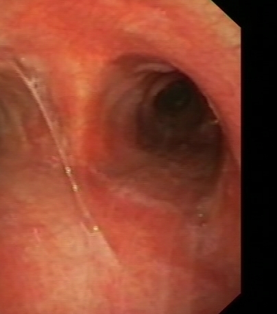 Erythematous mucosa