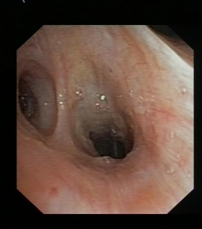 Normal Mucosa