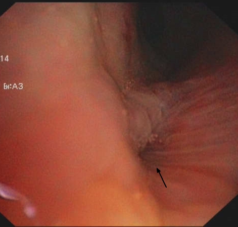 Broncho-oesophageal fistula