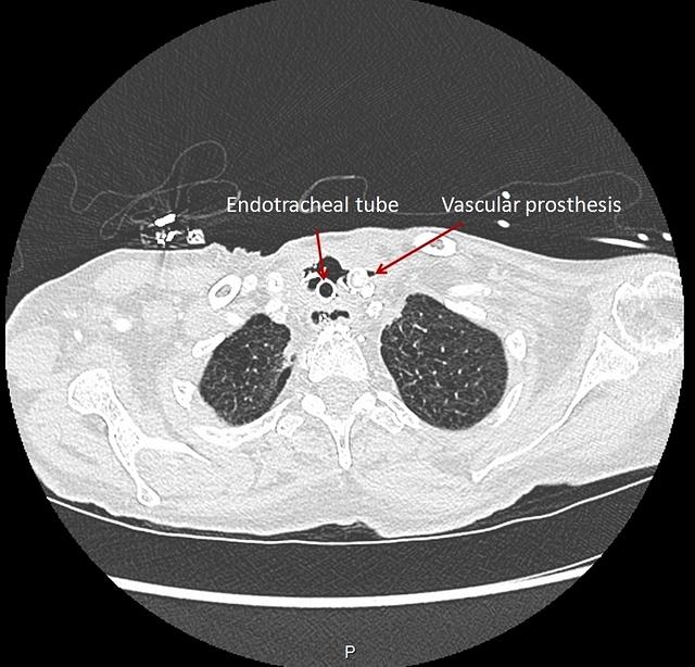 Tracheo-mediastinal fistula (CT scan)