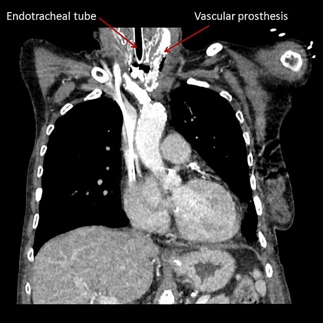 Tracheo-mediastinal fistula (CT scan)