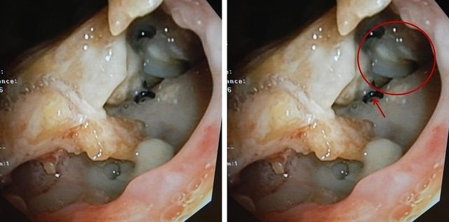 Tracheo-mediastinal fistula (arterial prosthesis)