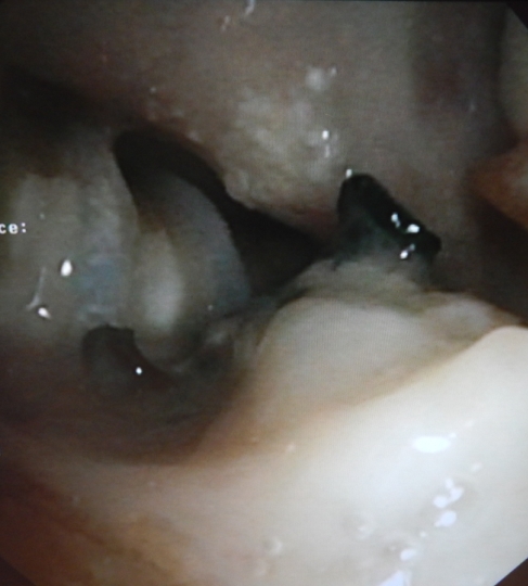 Tracheo-mediastinal fistula (arterial prosthesis)