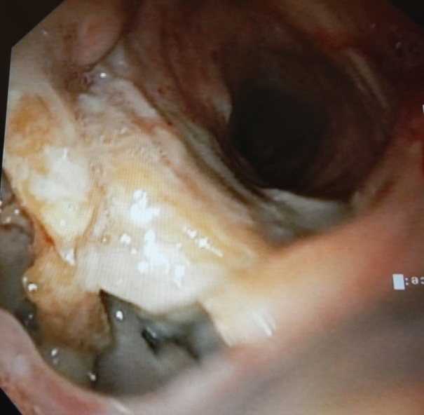 Tracheo-mediastinal fistula