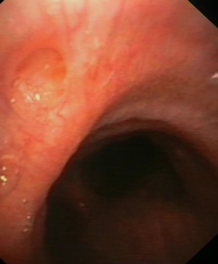 Shallow mucosal ulcer