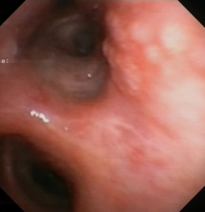 Nodular irregularity of the mucosa