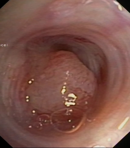 Exophytic lesion with a smooth surface