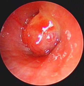 Exophytic mass with a smooth, shiny and erythematous surface