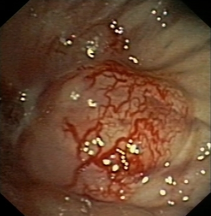 Hypervascularized endobronchial lesion