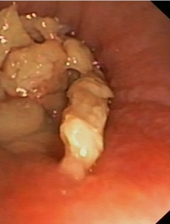 Exophytic necrotic lesion