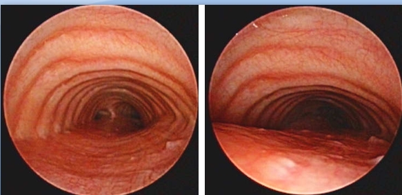 Excessive dynamic airway collapse (EDAC) associated with bronchomegaly