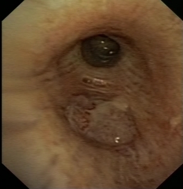Exophytic lesion obstructing the left lower lobe bronchus