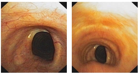 Tracheal stenosis post tracheostomy