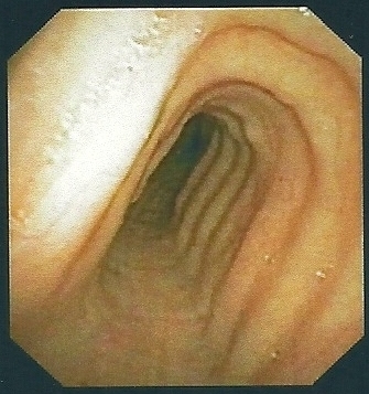 Saber-sheath trachea