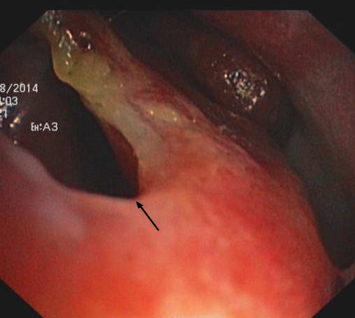 Perforation of the nasal septum