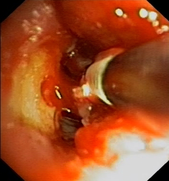 Cryotherapy: gradual cooling of the cryoprobe surface