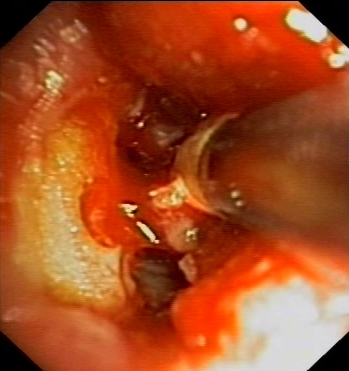 Cryotherapy: gradual cooling of the cryoprobe surface