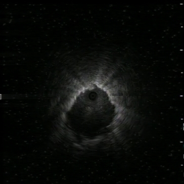 Radial US: nodule visualisation