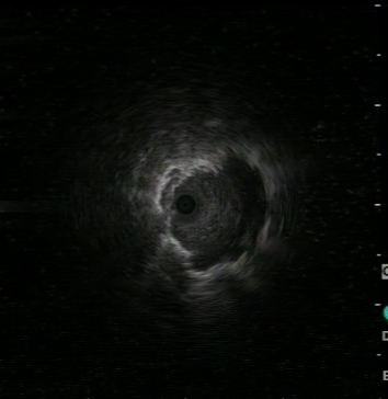 Radial US: nodule visualisation