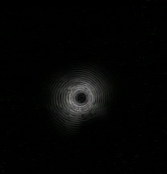 Radial ultrasound: normal (snowstorm image)