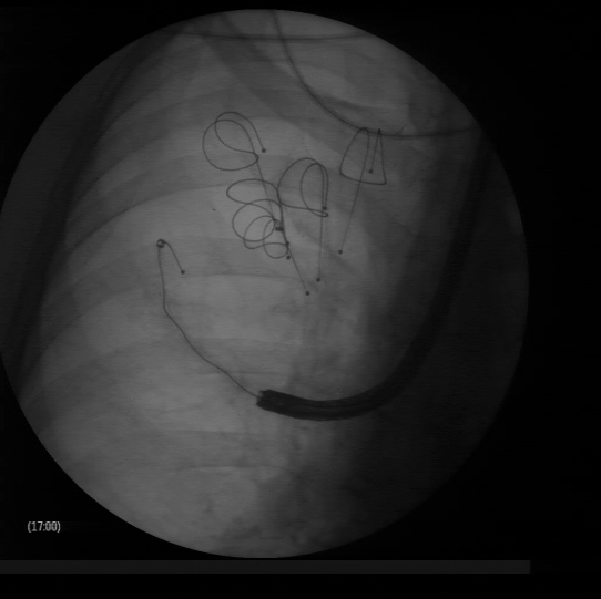 Lung volume reduction with coils: the coil is being deployed