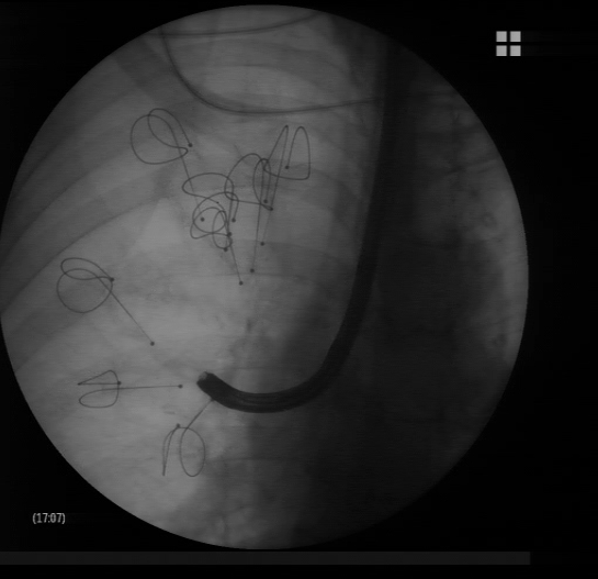 Lung volume reduction with coils: the coil has been completely deployed