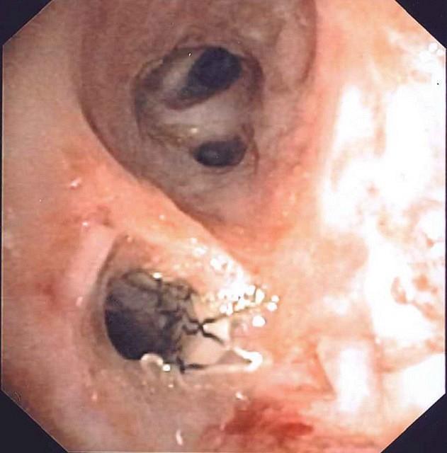 Endobronchial stent of the left lower lobe bronchus