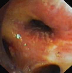 Patency of the right upper lobe bronchus after placement of an OKI stent