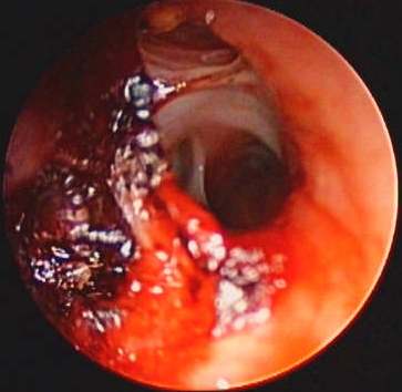 Endobronchial status after tumor deboulking of the truncus intermedius