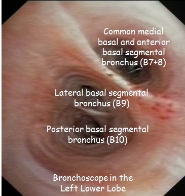 Left basal segmental bronchi - annotations