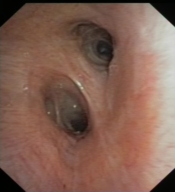 Left mainstem bronchus (distal part) 