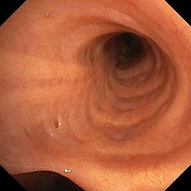 Left Mainstem Bronchus (proximal part)
