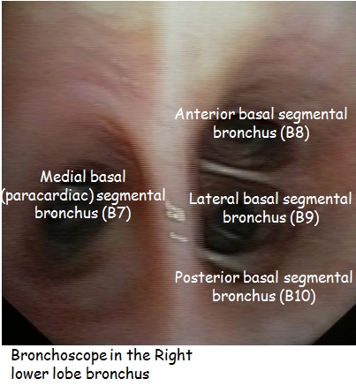 Right basal segmental bronchi