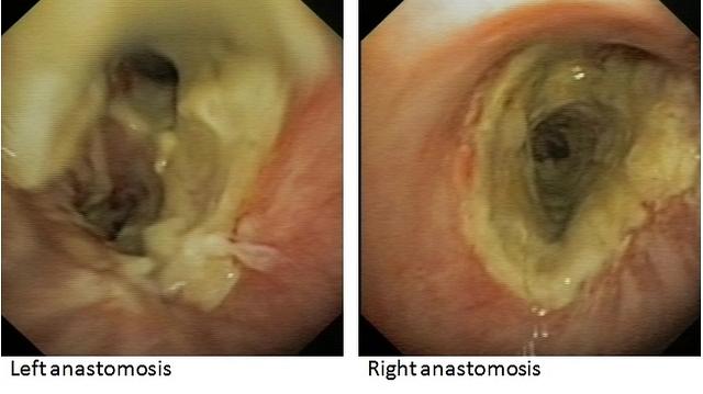 Anastomotic fibrin deposition: 1 month after transplantation