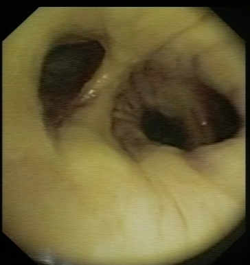 Extensive post anastomotic fibrin deposition: 1month after transplantation