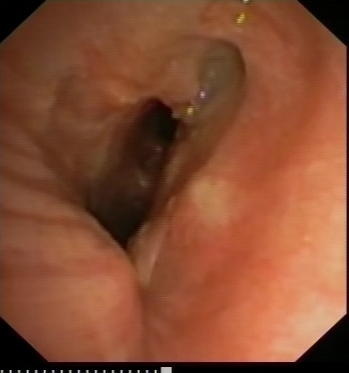 Distrortion and stenosis of the left anastomosis: 6 months after transplantation