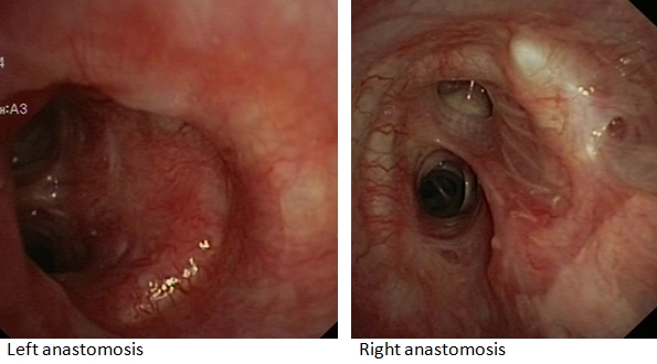 Lobar transplantation in a pediatric patient