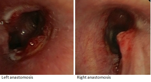 Anastomoses: 20 days after transplantation
