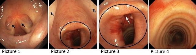 Tracheal stenosis after tracheostomy (stages of bronchoscopy, annotations)