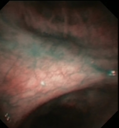 Metastatic melanoma (Narrow band imaging)