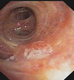 In situ epidermoid carcinoma of the lingula