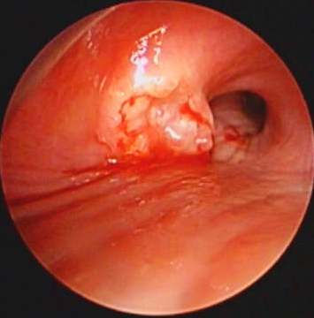 Endobronchial visualisation of the fistula