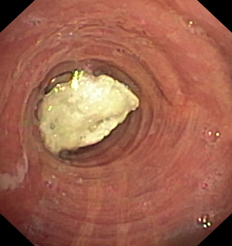 Pill impacted in the left mainstem bronchus