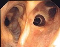 Anatomical variation right upper lobe bronchus